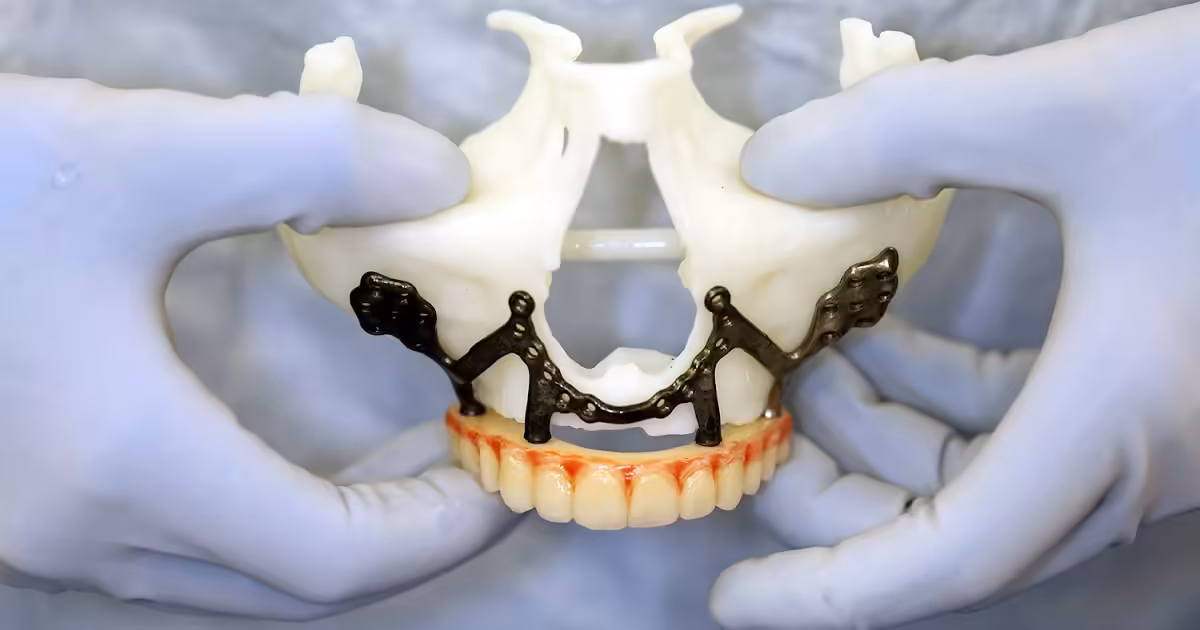 3-D Technology Advances Maxillofacial Reconstruction for Military Patients