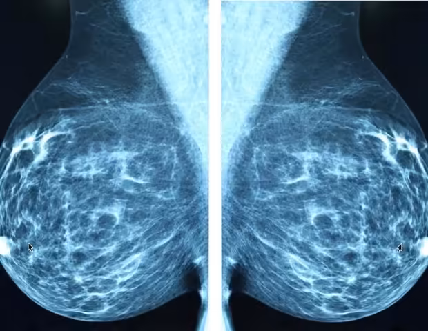 Finnish study finds poor oral health increases jawbone necrosis risks in breast cancer patients