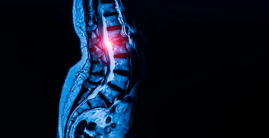 Hidden stem cells may be fueling spinal stenosis