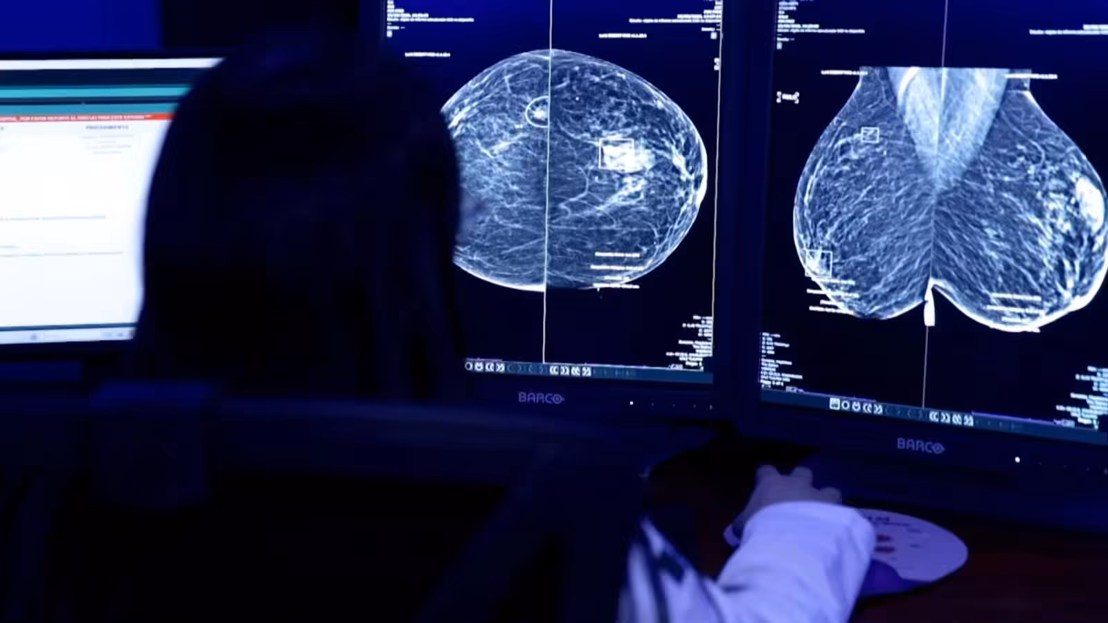How AI is helping Mexico detect breast cancer earlier | Science and Technology