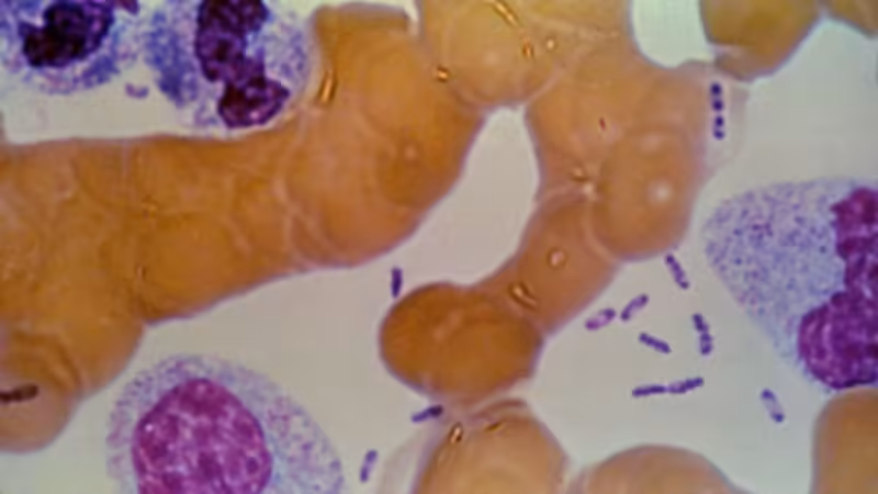 Pneumonic plague, by the numbers