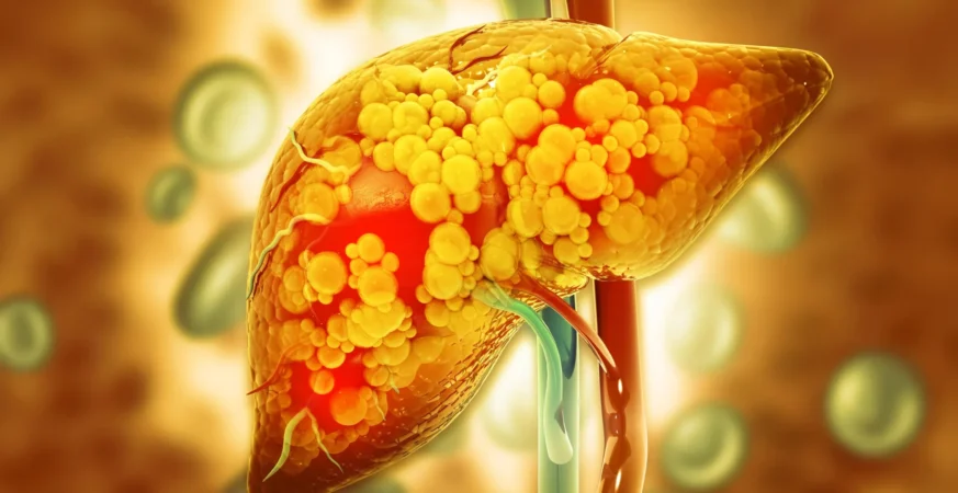 This protective enzyme could help stop fatty liver disease from getting worse